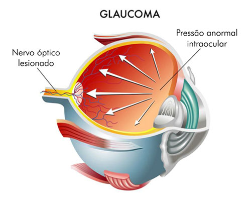 Comparação Glaucoma